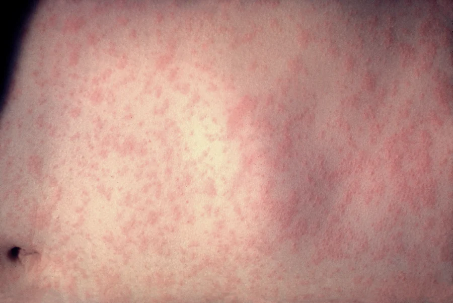 measles